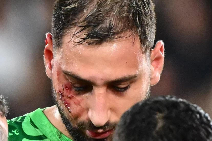 Photo de couverture de l'article Donnarumma défiguré : la faute non sanctionnée de Singo qui choque le PSG